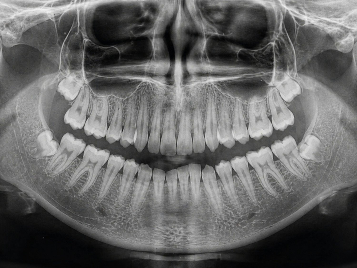 A panoramic dental x-ray showing teeth and jawbone, part of the exam required after separation